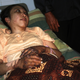Indonesian domestic helper Erwiana Sulistyaningsih lies in a bed whilst being treated at a hospital in Indonesia.